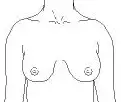 Breasts after a mastopexy