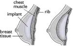 Breast Implants
