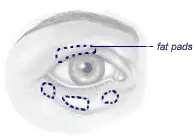 Blepharoplasty 2