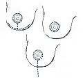 Different types of scar lines after a mastopexy