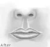 Lip Enhancement 3