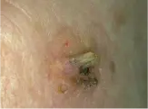 This is an early squamous cell carcinoma.