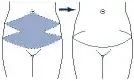 Fig 3. Extended abdominoplasty - the scar extends around the flanks onto the lower back.