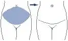 Fig 1. Standard abdominoplasty