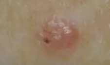 This shows a small but typical basal cell carcinoma.