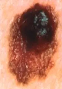 This is a melanoma. Note it has an irregular shape and irregular pigmentation. These are all typical features of melanoma.