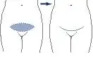 Fig 2. Mini abdominoplasty