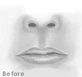 Lip Enhancement 1