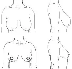 Breast reduction