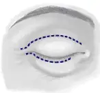 Blepharoplasty